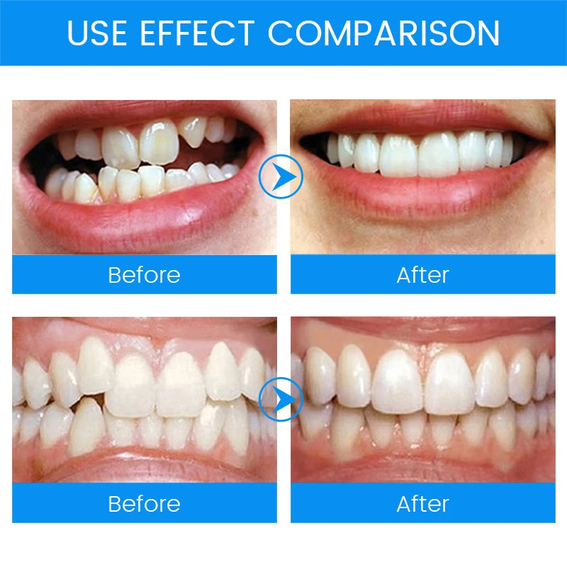 3 Stages Dental Orthodontic Br - Teeth Whitening Mouth Guard 评论和价格